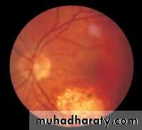 Ophthalmology Lecture Notes