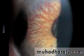 Ophthalmology Lecture Notes