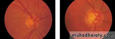 Ophthalmology Lecture Notes