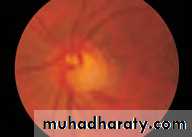 Ophthalmology Lecture Notes