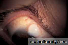 Ophthalmology Lecture Notes