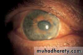 Ophthalmology Lecture Notes