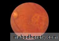 Ophthalmology Lecture Notes