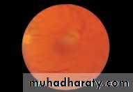 Ophthalmology Lecture Notes