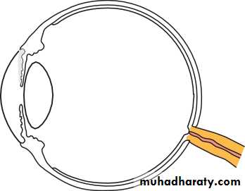 Ophthalmology Lecture Notes