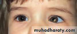 Ophthalmology Lecture Notes