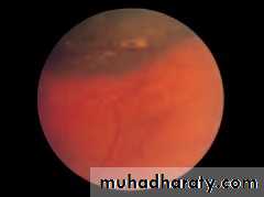 Ophthalmology Lecture Notes