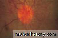 Ophthalmology Lecture Notes