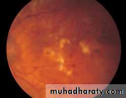 Ophthalmology Lecture Notes
