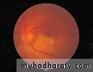 Ophthalmology Lecture Notes
