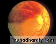 Ophthalmology Lecture Notes