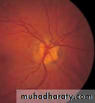 Ophthalmology Lecture Notes