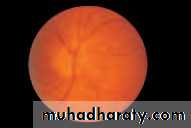Ophthalmology Lecture Notes