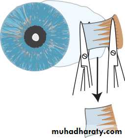 Ophthalmology Lecture Notes