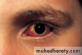 Ophthalmology Lecture Notes