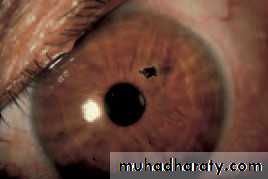 Ophthalmology Lecture Notes