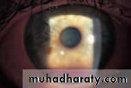 Ophthalmology Lecture Notes