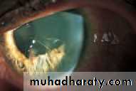 Ophthalmology Lecture Notes