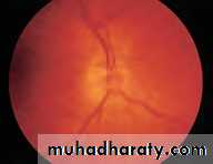 Ophthalmology Lecture Notes