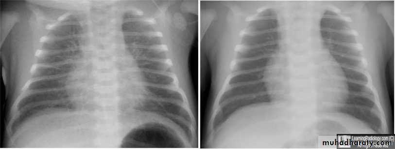 Transient tachypnea of new bowrn