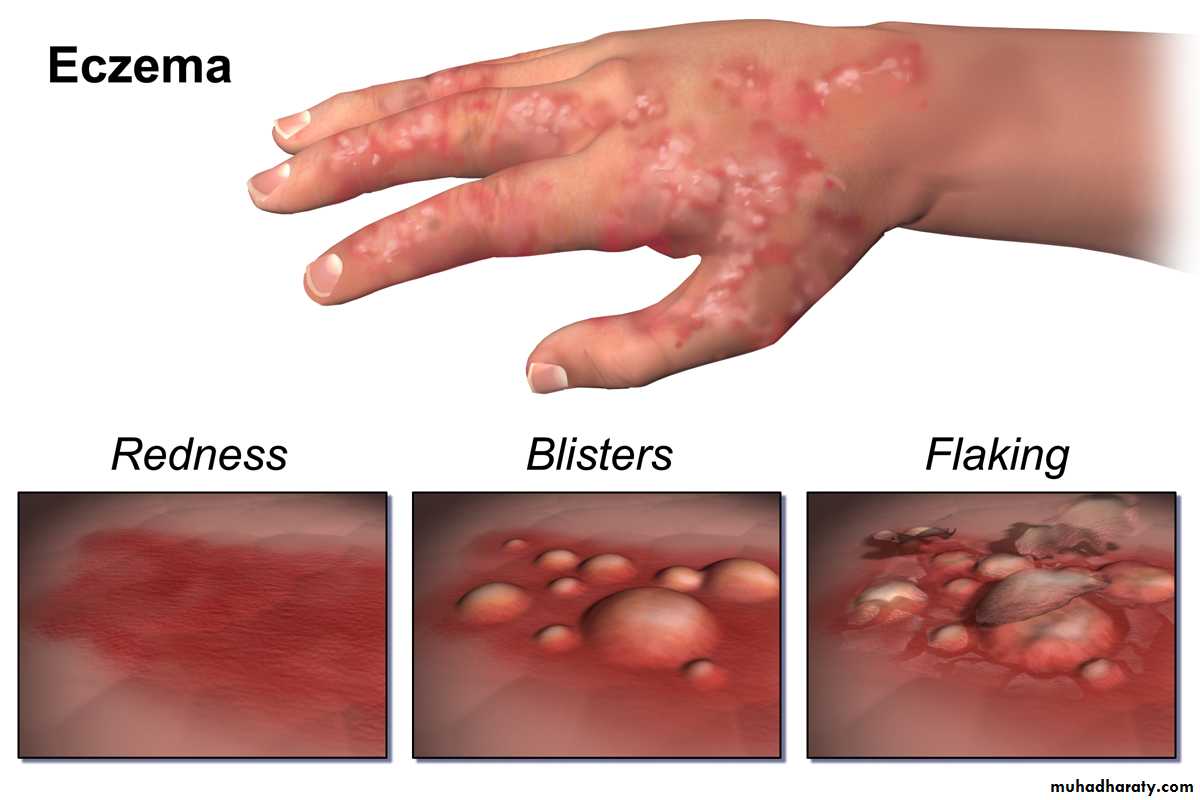 ENDOGENOUS ECZEMA