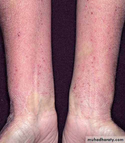 ENDOGENOUS ECZEMA