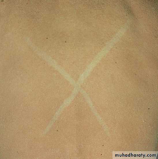 ENDOGENOUS ECZEMA