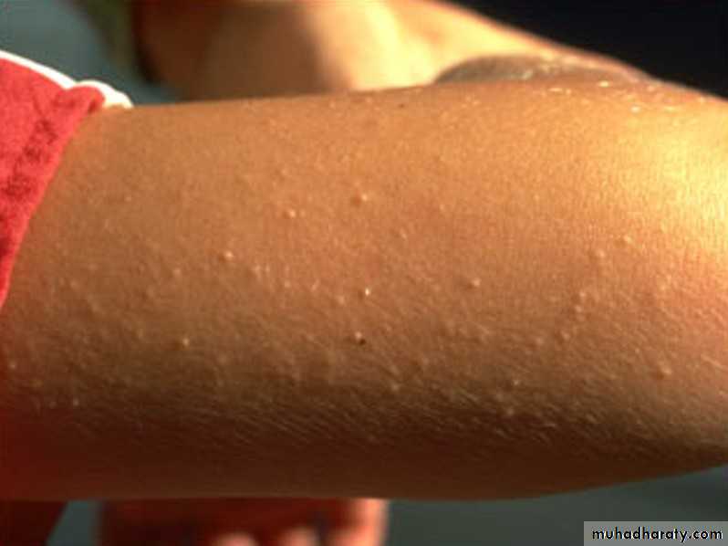 ENDOGENOUS ECZEMA