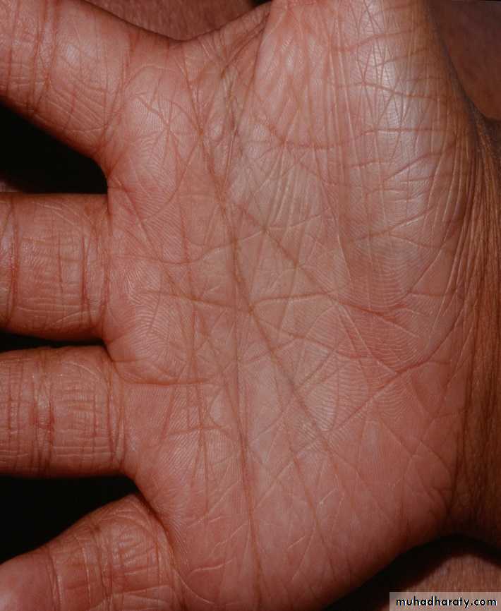 ENDOGENOUS ECZEMA