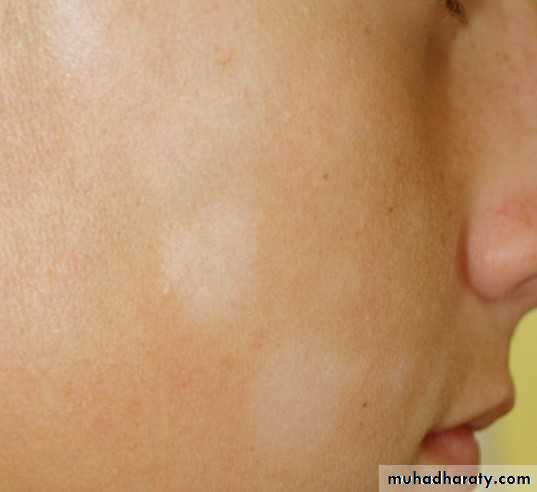 ENDOGENOUS ECZEMA