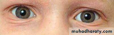 ENDOGENOUS ECZEMA