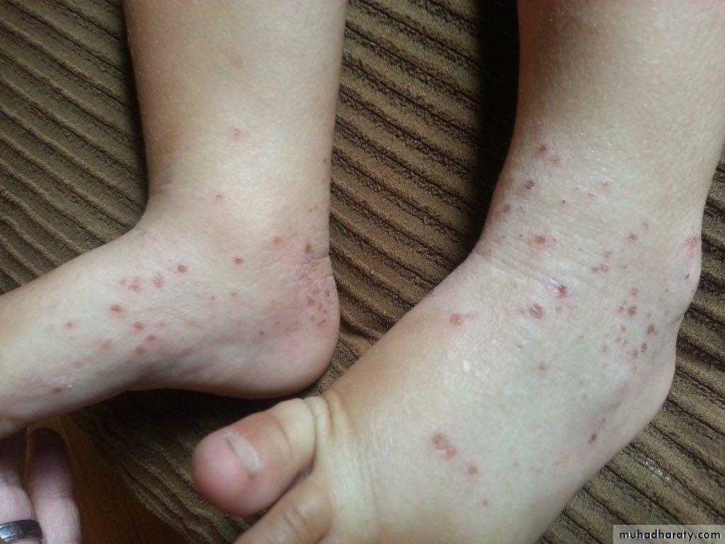 ENDOGENOUS ECZEMA