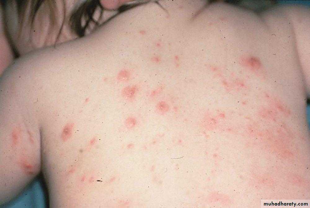 ENDOGENOUS ECZEMA