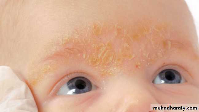 ENDOGENOUS ECZEMA