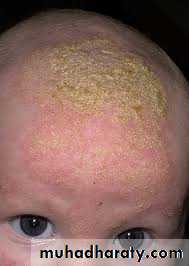 ENDOGENOUS ECZEMA