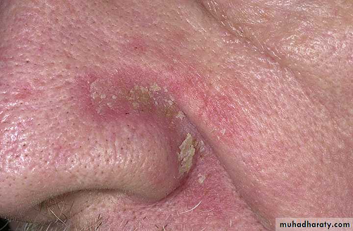 ENDOGENOUS ECZEMA