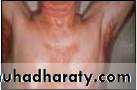 ENDOGENOUS ECZEMA