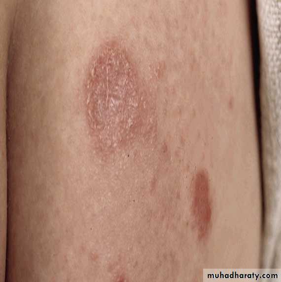 ENDOGENOUS ECZEMA