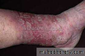 ENDOGENOUS ECZEMA