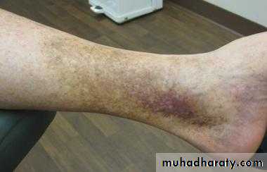 ENDOGENOUS ECZEMA
