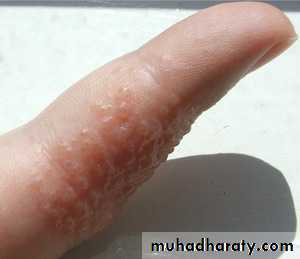 ENDOGENOUS ECZEMA