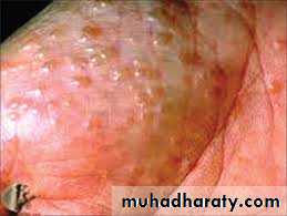 ENDOGENOUS ECZEMA