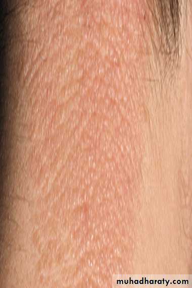 ENDOGENOUS ECZEMA