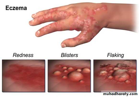 ENDOGENOUS ECZEMA