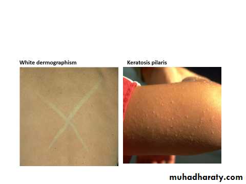 ENDOGENOUS ECZEMA