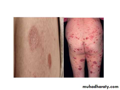 ENDOGENOUS ECZEMA