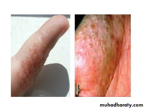 ENDOGENOUS ECZEMA