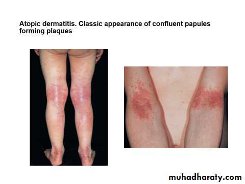 ENDOGENOUS ECZEMA