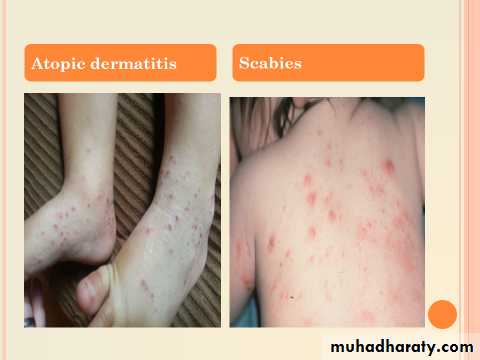 ENDOGENOUS ECZEMA