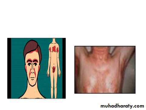 ENDOGENOUS ECZEMA